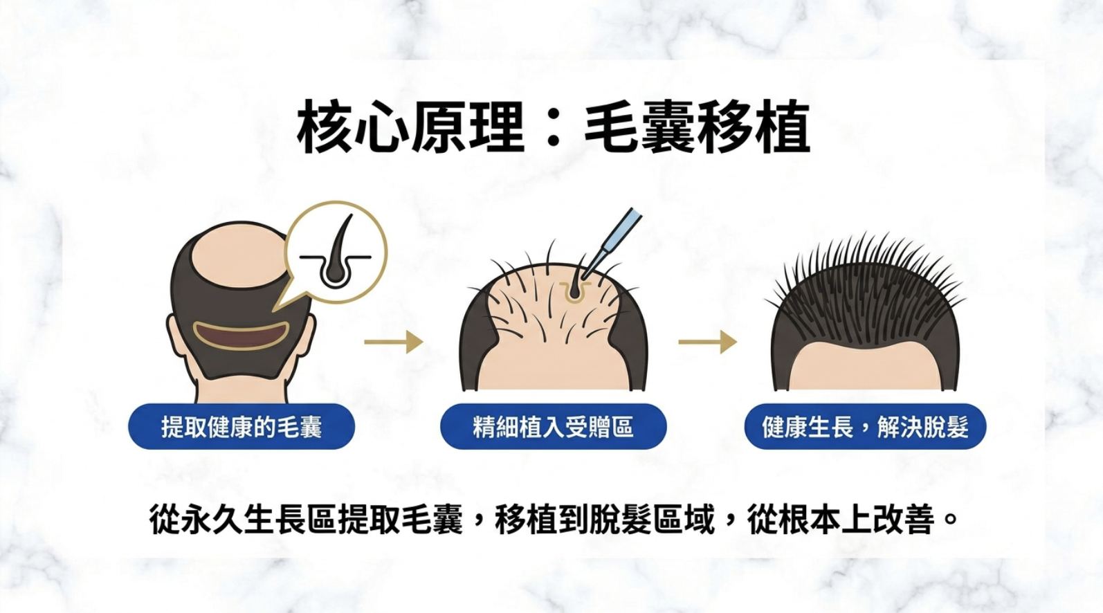 核心原理 毛囊移植 核心原理 毛囊移植