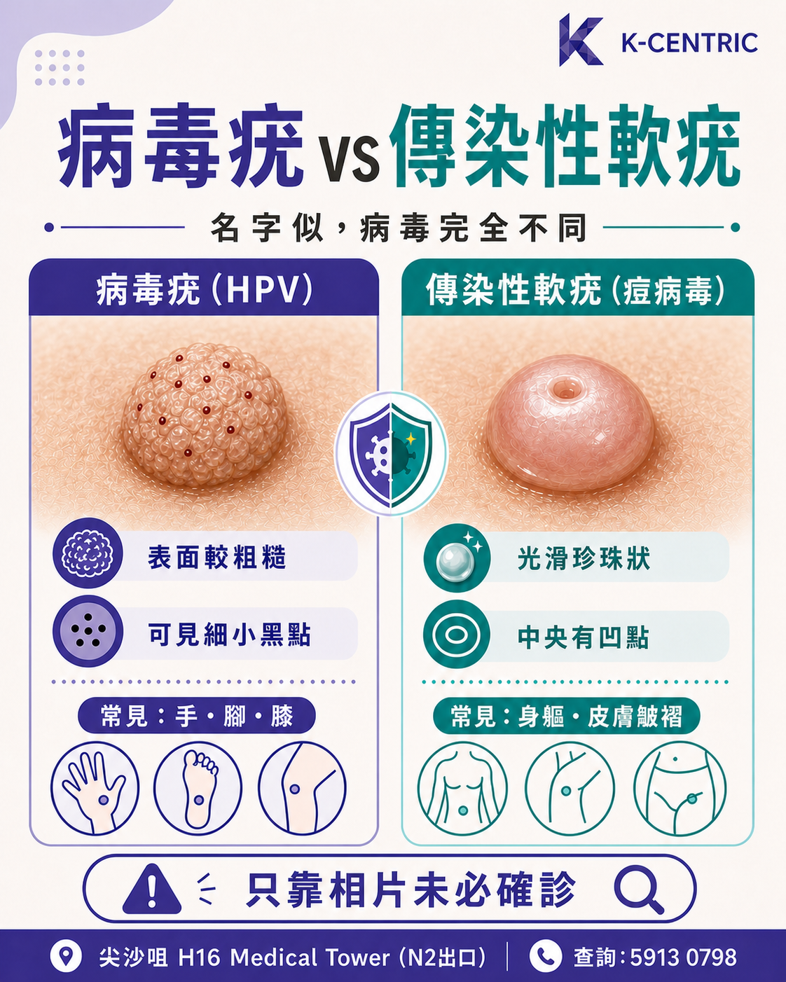 病毒疣與傳染性軟疣外觀比較 兒童病毒疣與傳染性軟疣比較圖,展示病毒來源、表面、黑點、中央凹點及常見位置