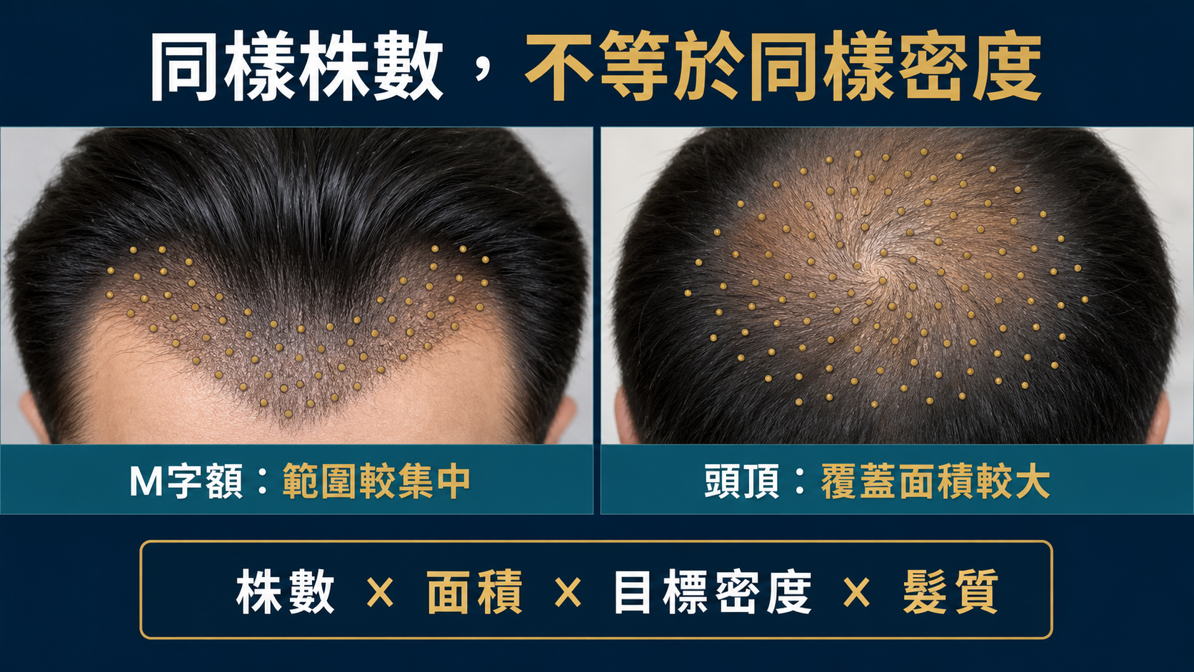 相同毛囊株數分配到M字額小範圍與頭頂大範圍的視覺差異