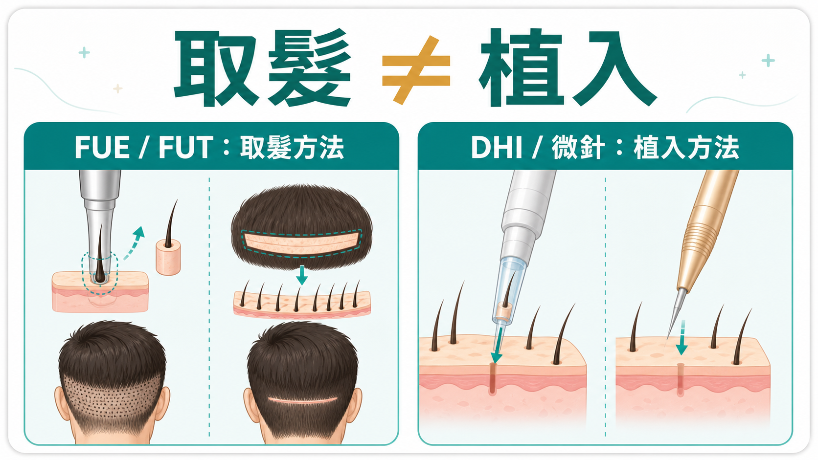 取髮不等於植入 FUE FUT 是取髮方法 DHI 微針是植入方法