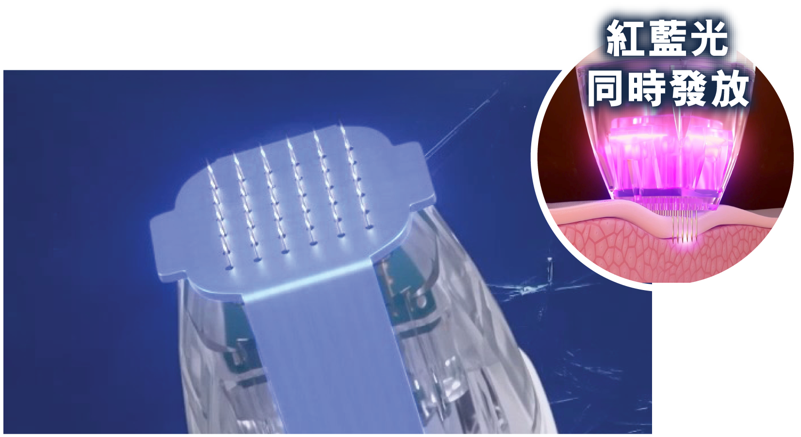 Virtue RF 黃金微針 Virtue RF 黃金微針