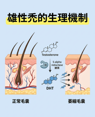 這張插圖以專業且清晰的方式，展示了睪固酮轉化為 DHT（二氫睪固酮），進而攻擊毛囊導致萎縮的生物學機制。
