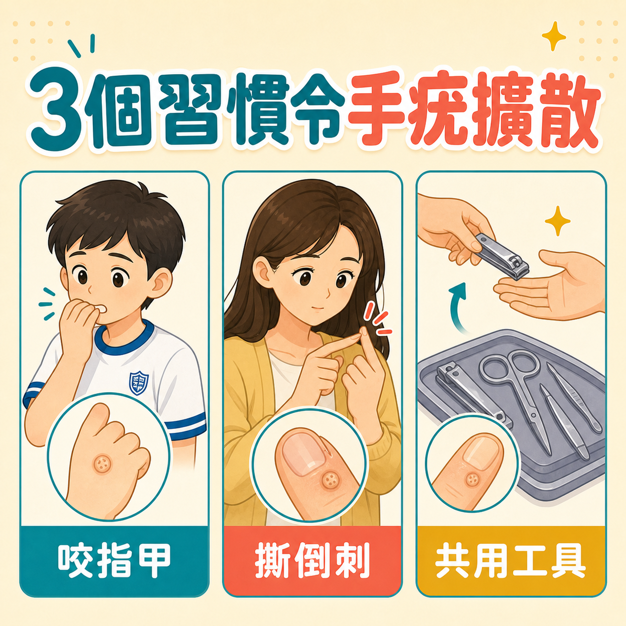 咬指甲撕倒刺及共用修甲工具可能令手疣擴散