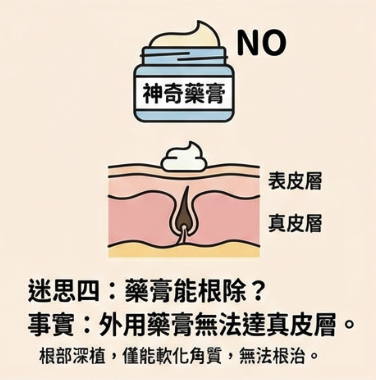 迷思四:市面上的藥膏能根除汗管瘤? 迷思四:市面上的藥膏能根除汗管瘤?