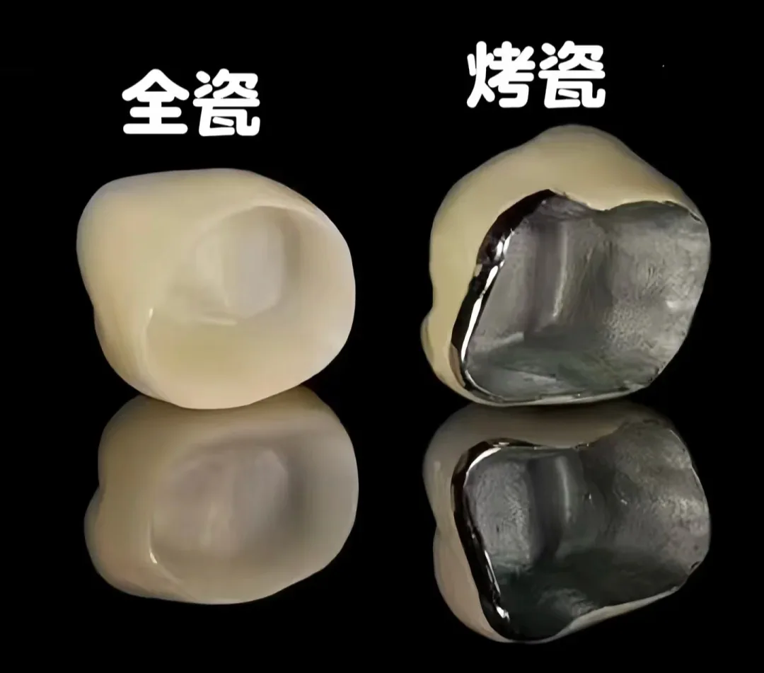 全瓷牙貼片:讓您的笑容重現自然光采!了解全瓷牙與烤瓷牙的差異,聰明選擇最佳美學修復方案