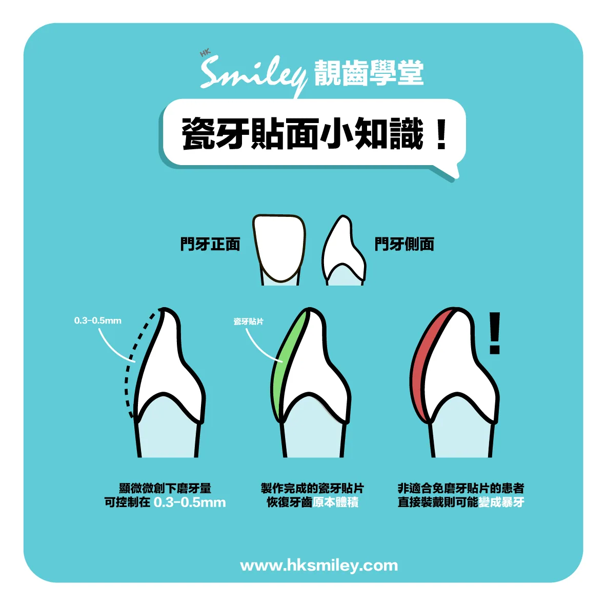 做全瓷牙貼真的可以不磨牙嗎?選擇時留意3點免踩雷!