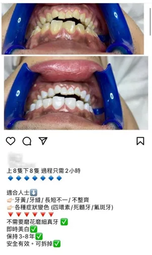 貪平搵「山寨牙醫」整牙貼!小心換來一口爛牙!