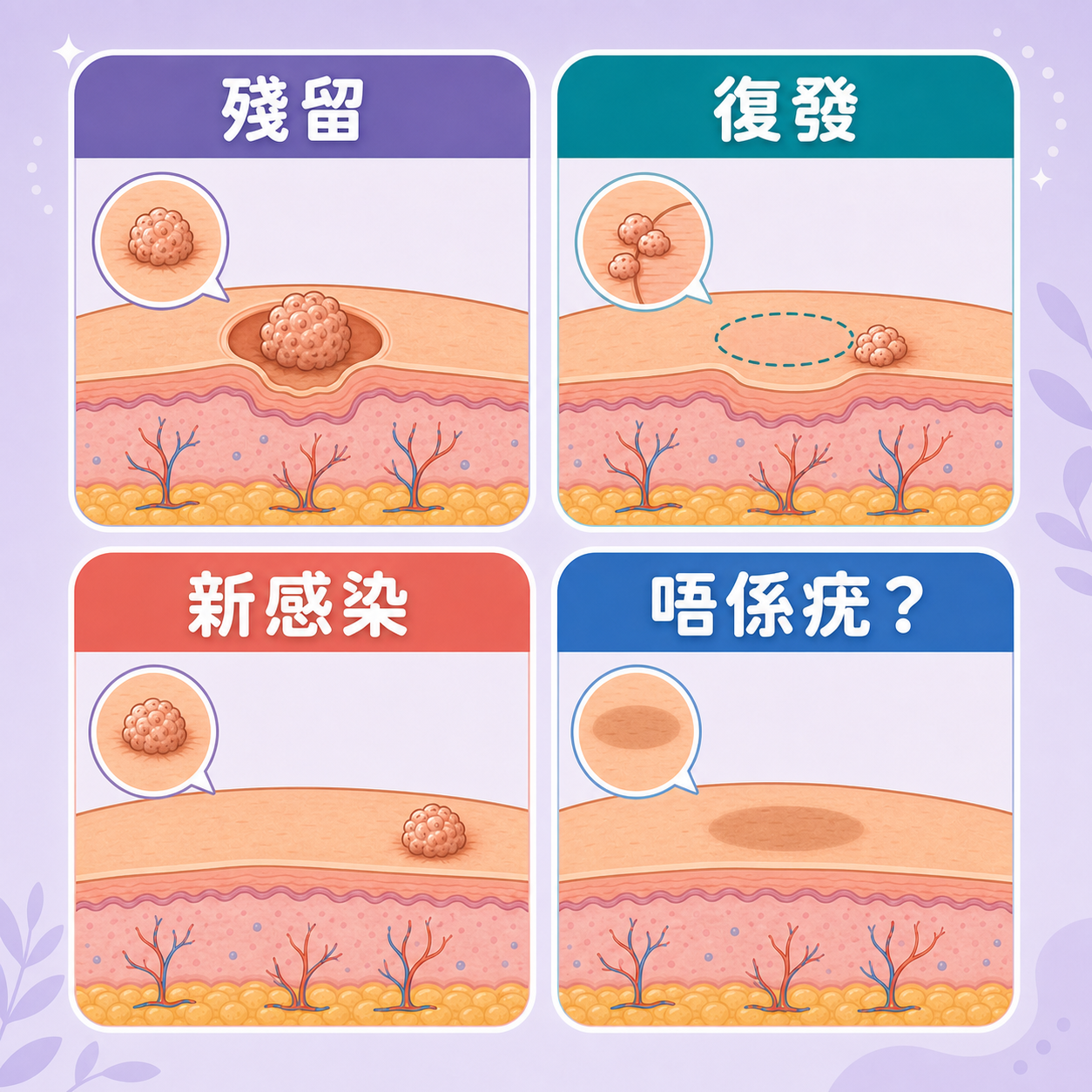 脫疣後粒粒四種可能 脫疣後殘留復發新感染與非疣粒粒四種情況對比圖