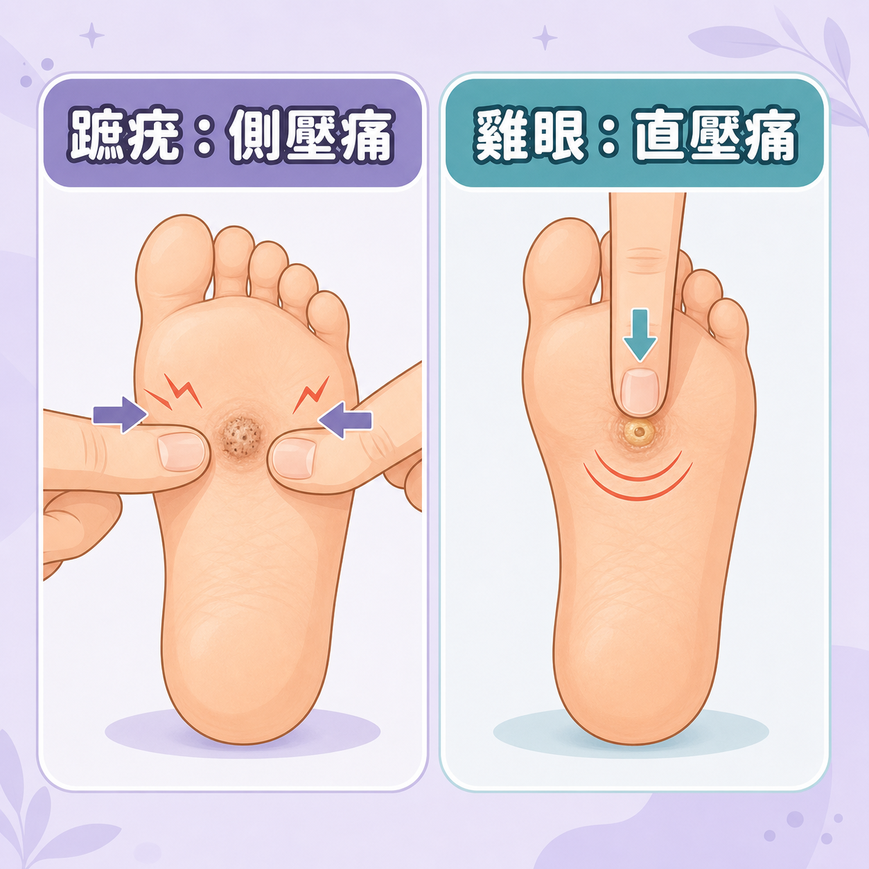 蹠疣與雞眼壓痛分辨 足底蹠疣與雞眼分辨圖比較側壓痛與直壓痛