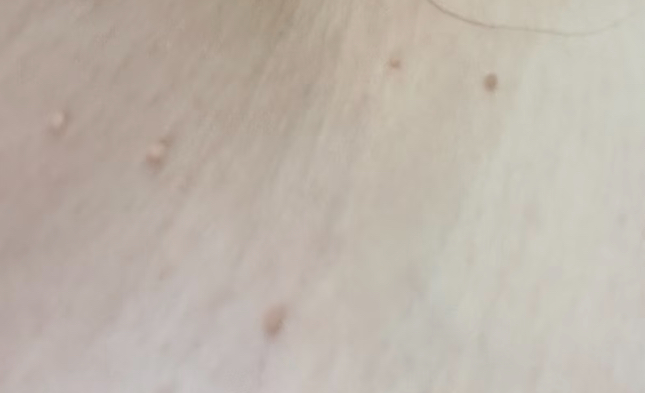 絲狀疣圖片