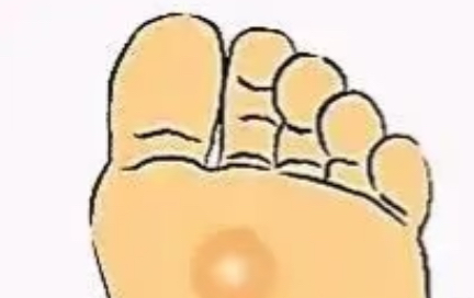 雞眼示意圖