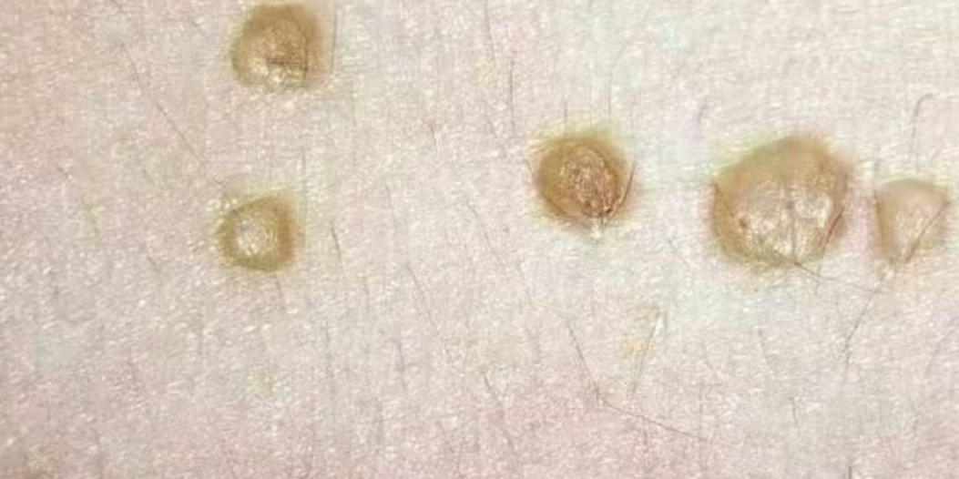 扁平疣圖片