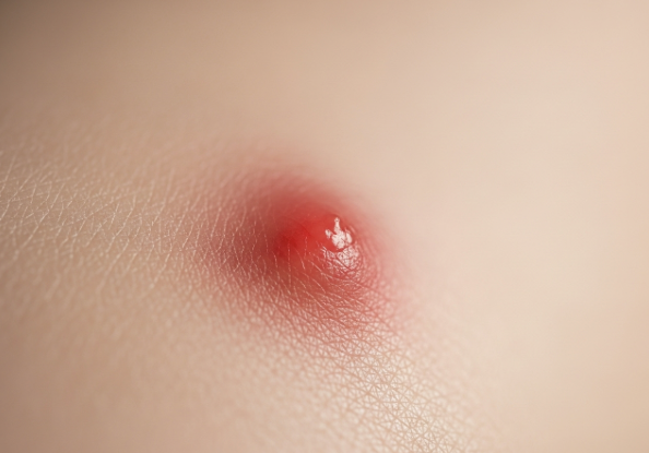 Abstract close-up of an inflamed red acne lesion, symbolizing the pain and inflammation of a pimple.