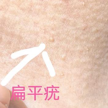 扁平疣初期照片