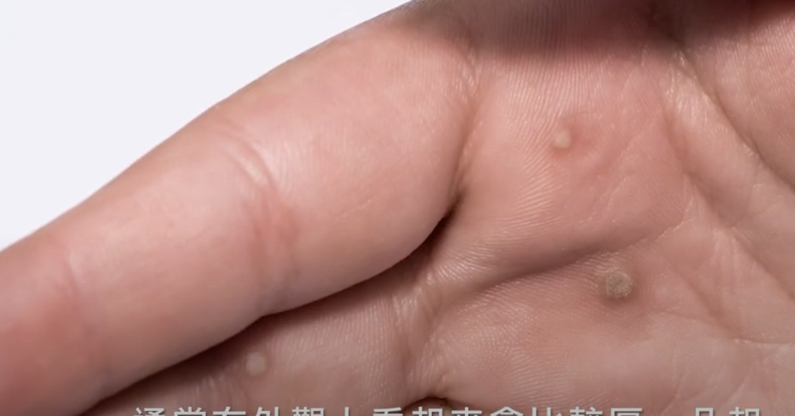 尋常疣真實圖片